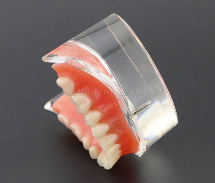 Dentes dentais modelo sobredentadura inferior com 2 implantes 6002 01